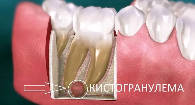 Когда все-таки удаляют зуб с кистой или гранулемой?